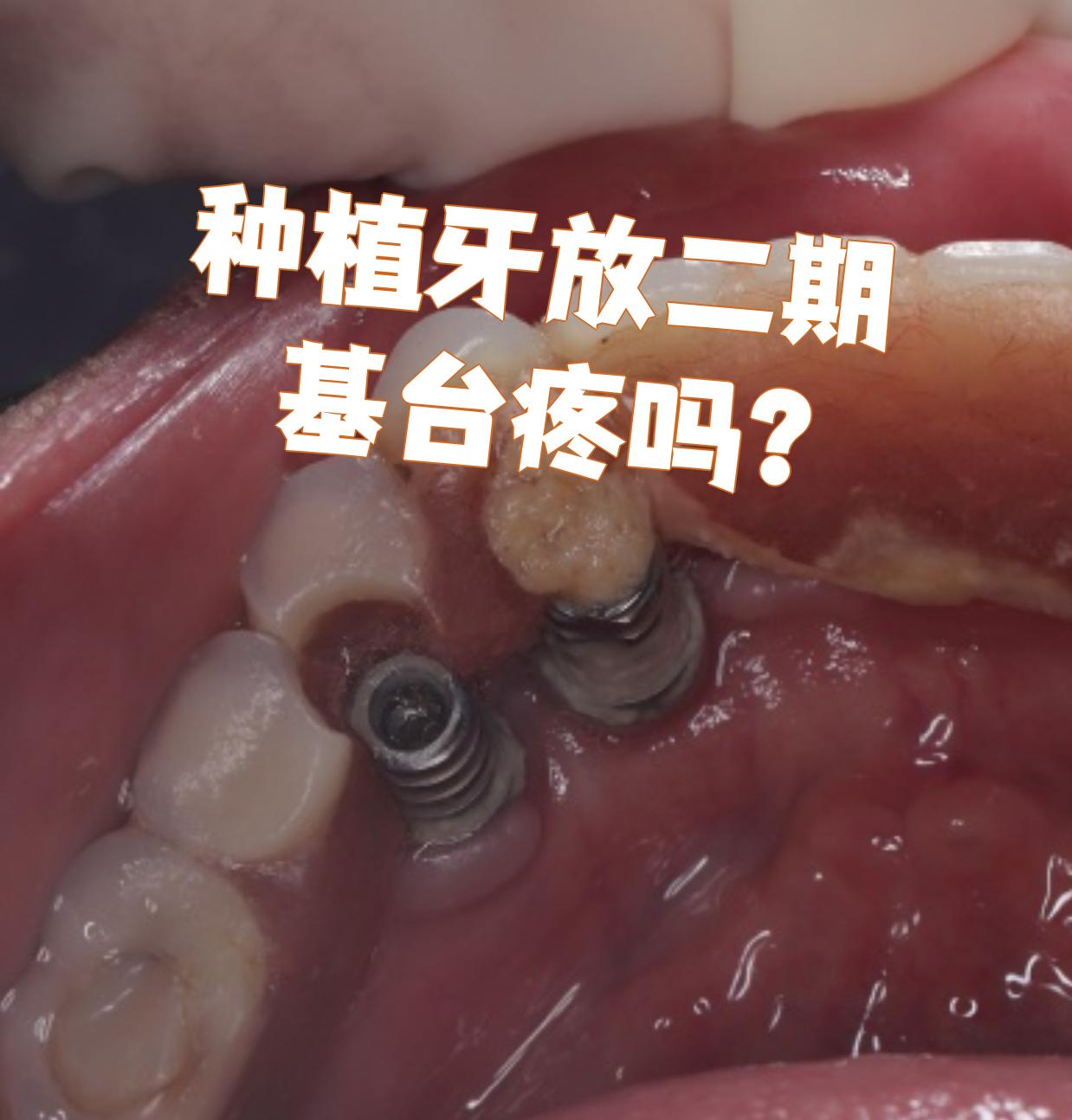 种植牙放二期基台疼吗?