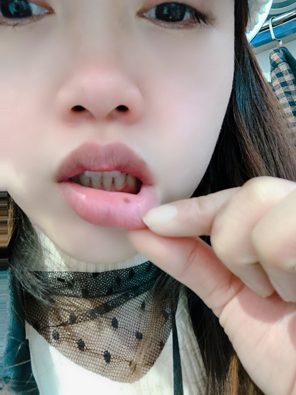 最近几年嘴唇上长的黑痣,有没有影响啊?