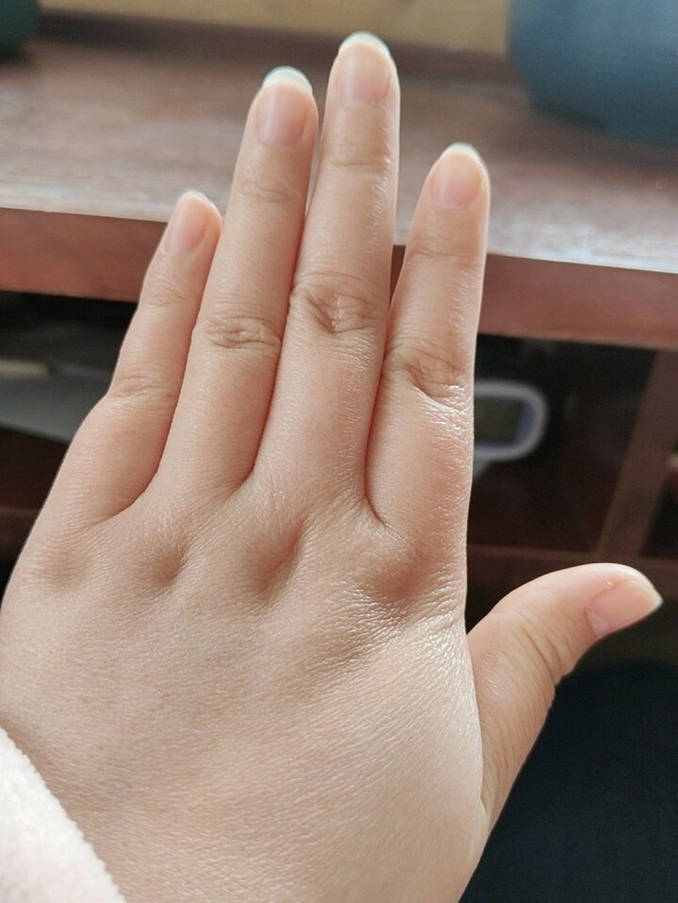 手上怎么那么多小窝窝