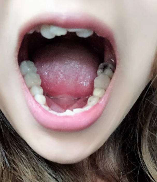 下排牙齿最里面的牙齿中间黑了?