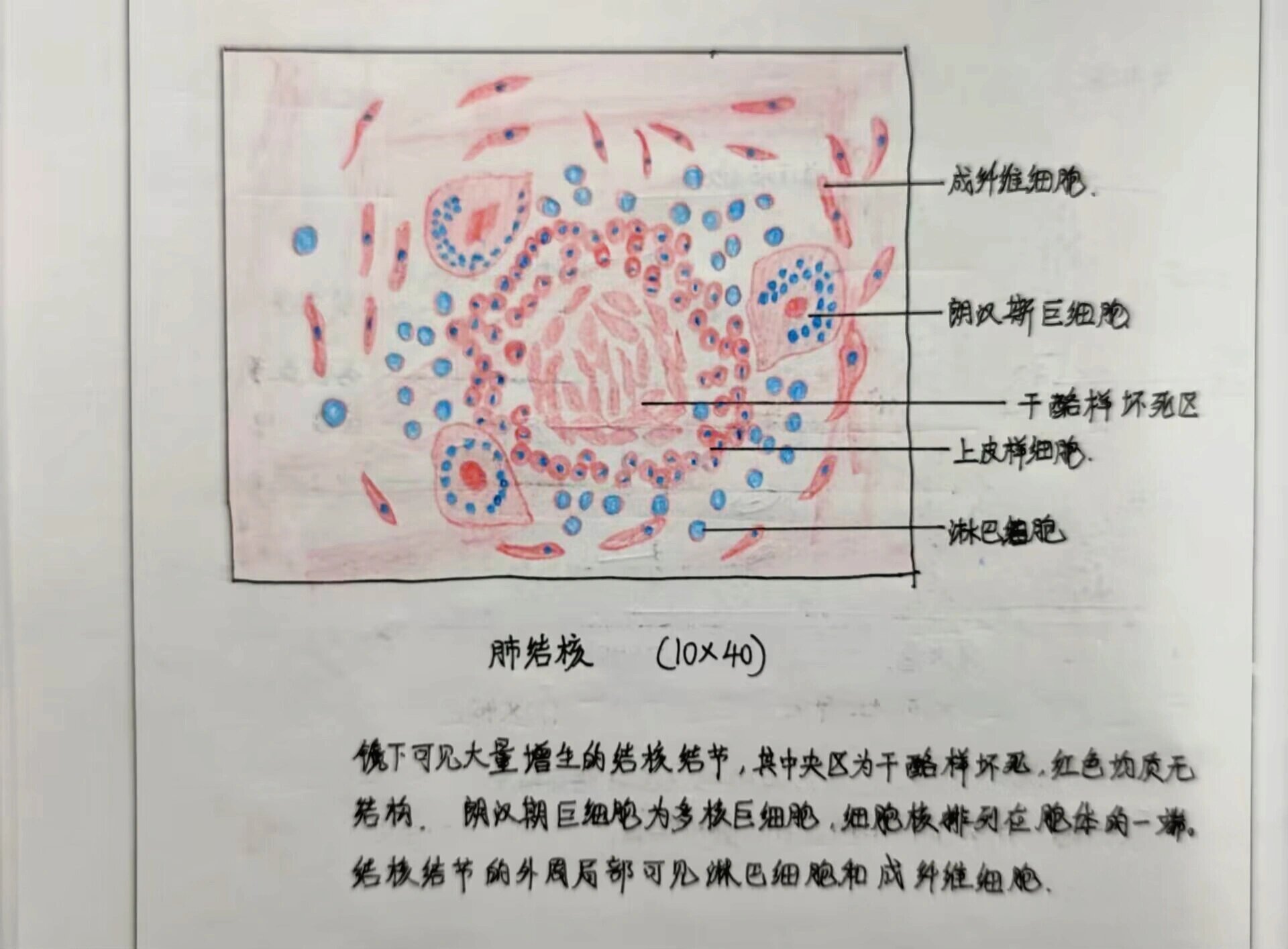 结核结节实验报告图片