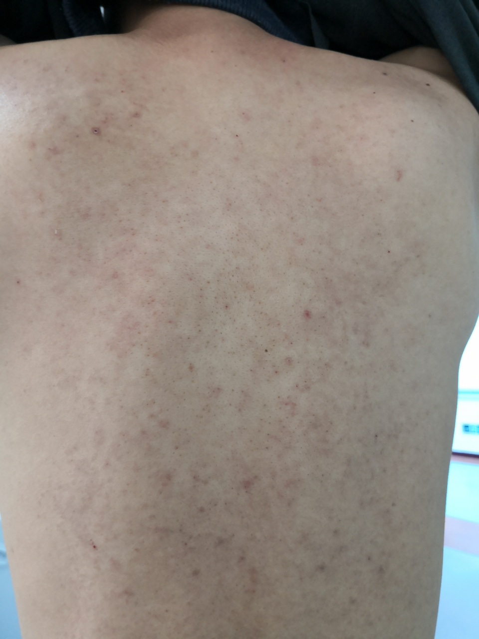 背部过敏症状.要排查一下马拉色菌毛囊炎症状#湿疹##毛囊炎