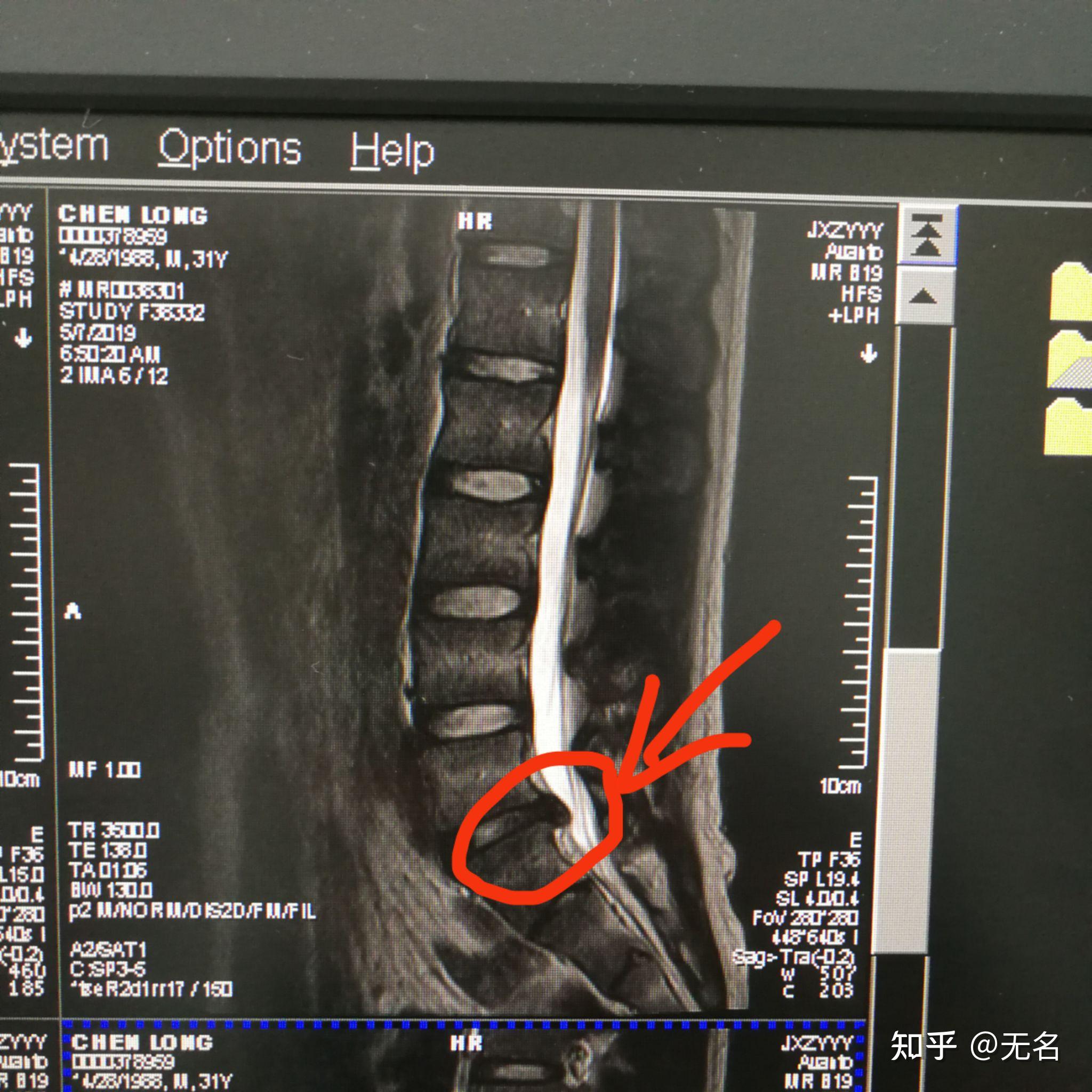 做了腰间盘突出微创手术以后多久可以投入正常生活呢