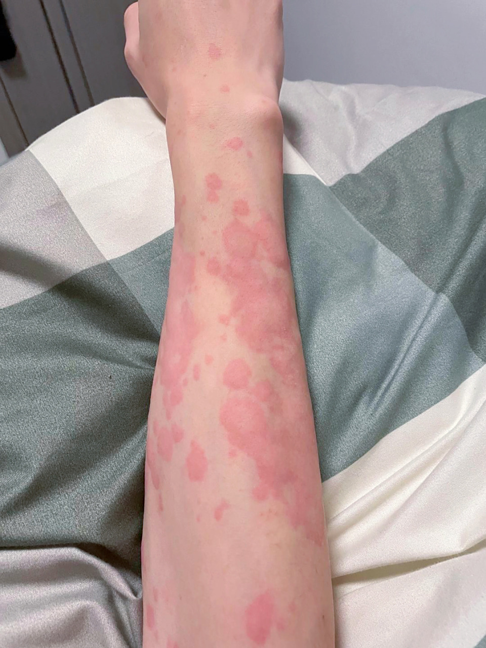 这法子对急性荨麻疹真的巨巨管用 真的建议大家都试试,我的荨麻疹就是