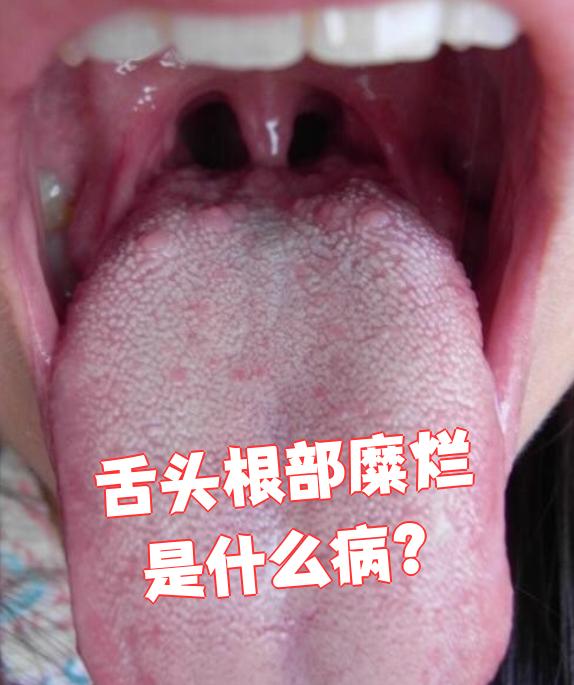 舌根部溃疡通常由外伤引起