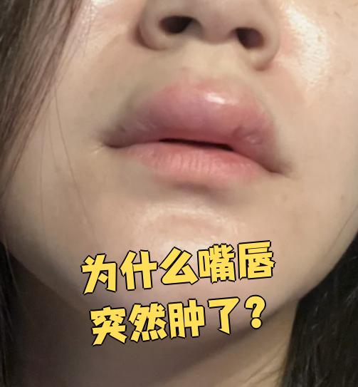 嘴唇为什么肿了