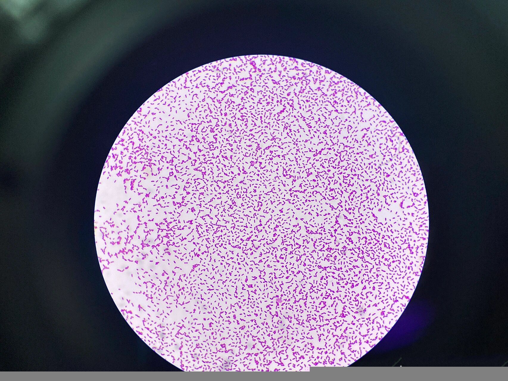 肺炎克雷伯氏菌 病例分享二 02痰 合格标本革兰染色:白细胞周围可见