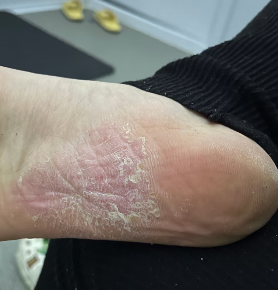 脚底生癣其实就是足癣,治疗主要有三种方法:一般治疗,外用药物和