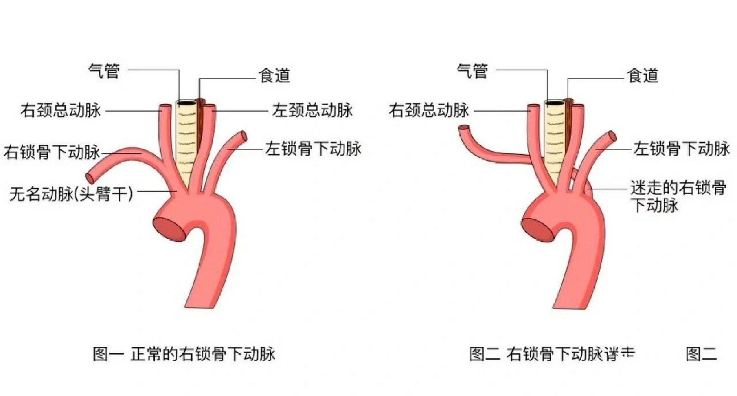 锁骨下动脉位置图片图片