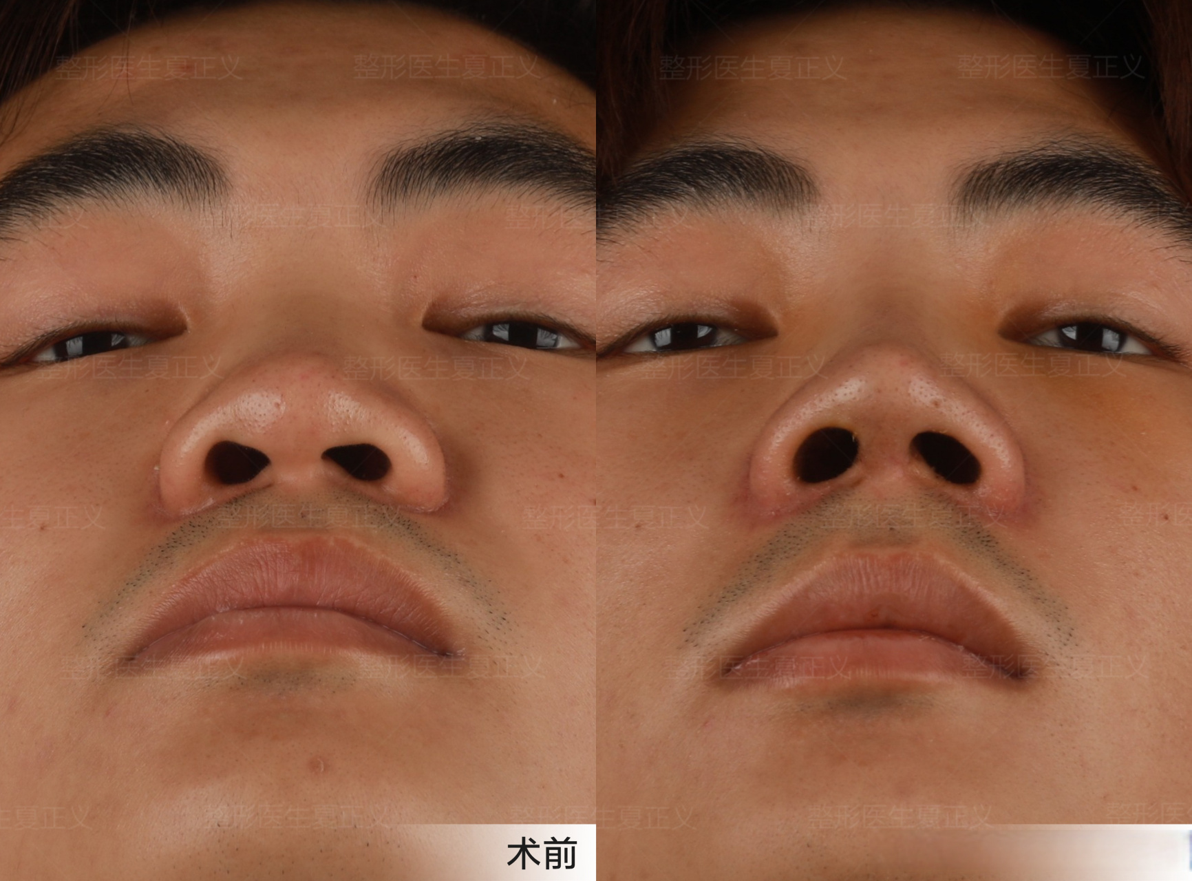 之前鼻子又扁又塌,鼻头大,视觉上拉宽了脸的横向比例,让原本宽的脸