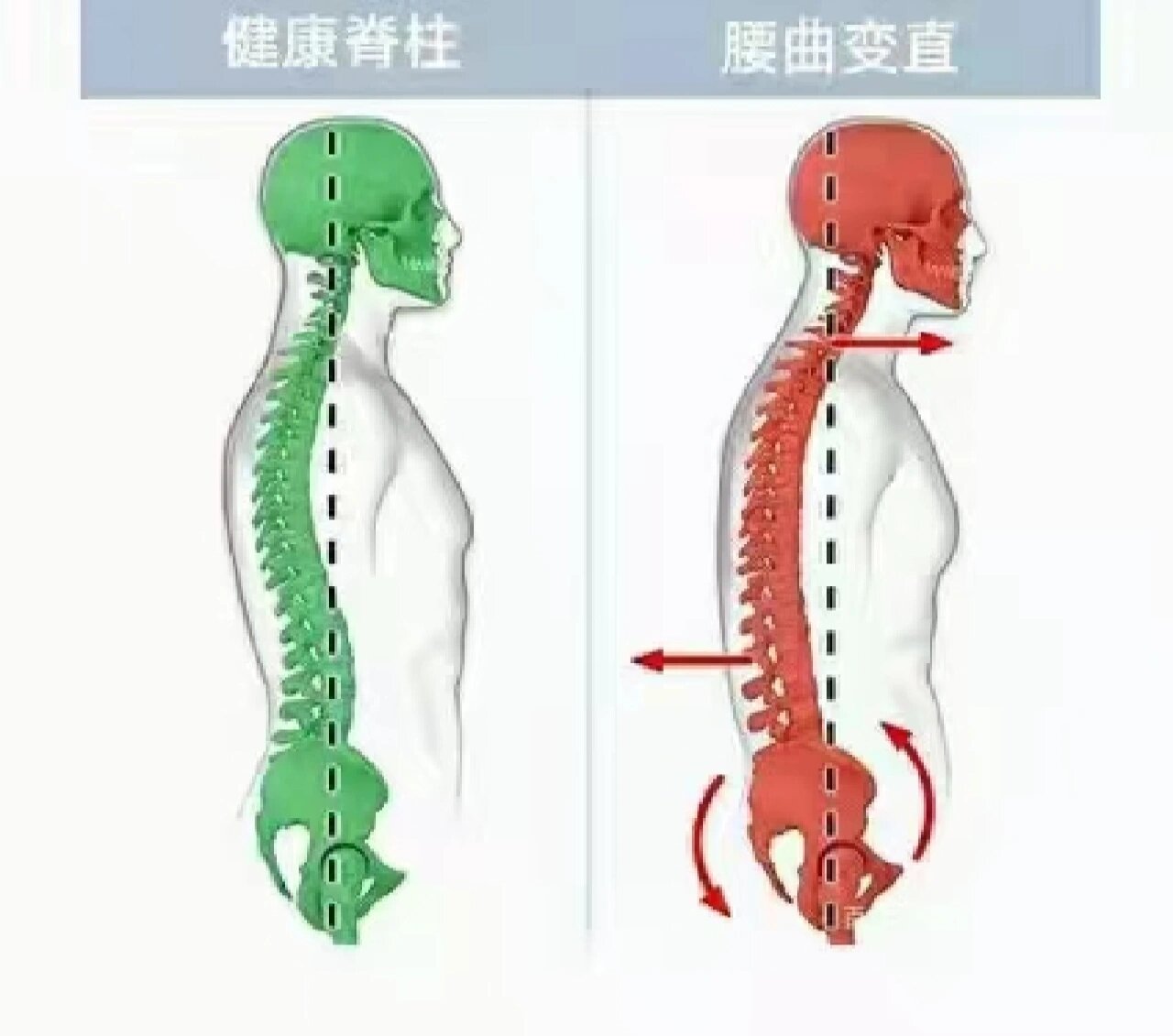 如果腰椎曲度变直,也是腰椎退化的一种表现,但大多数是平时不良生活