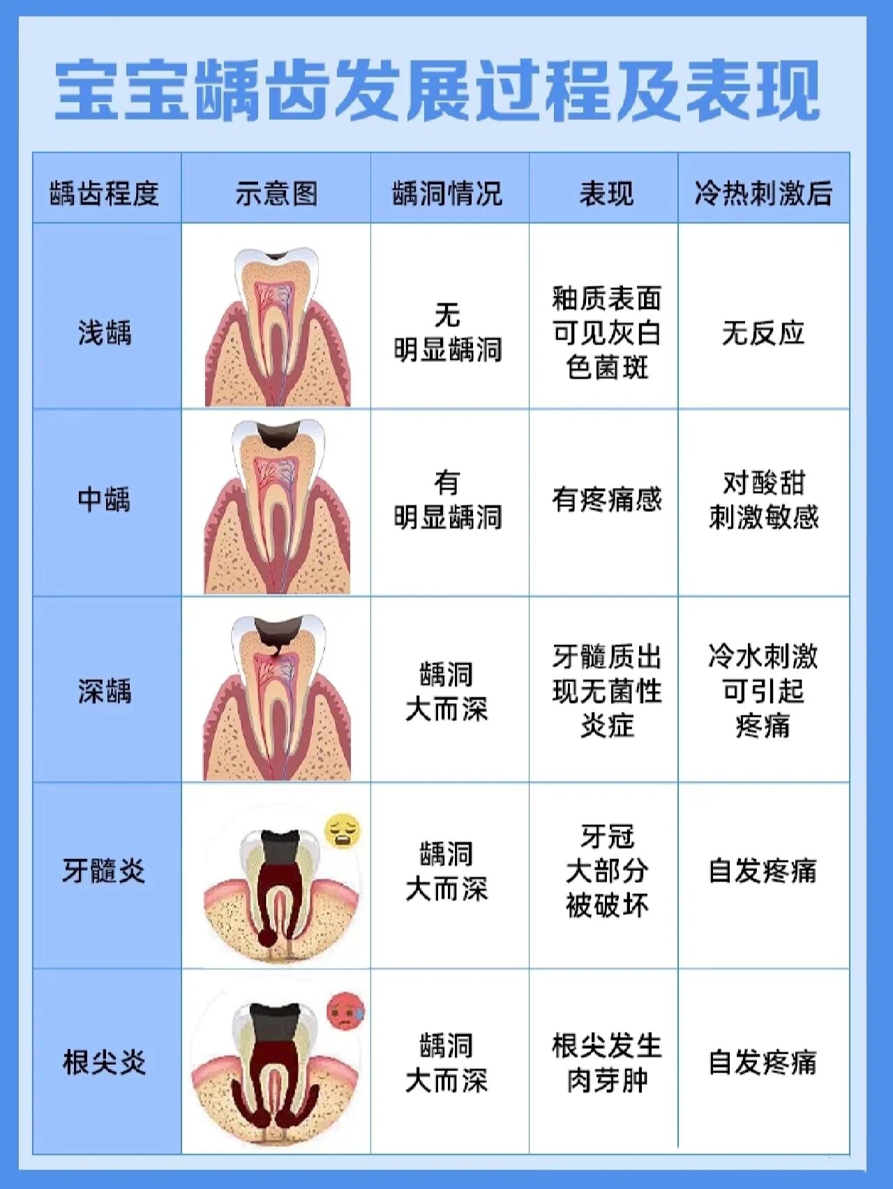 龋齿发展过程示意图