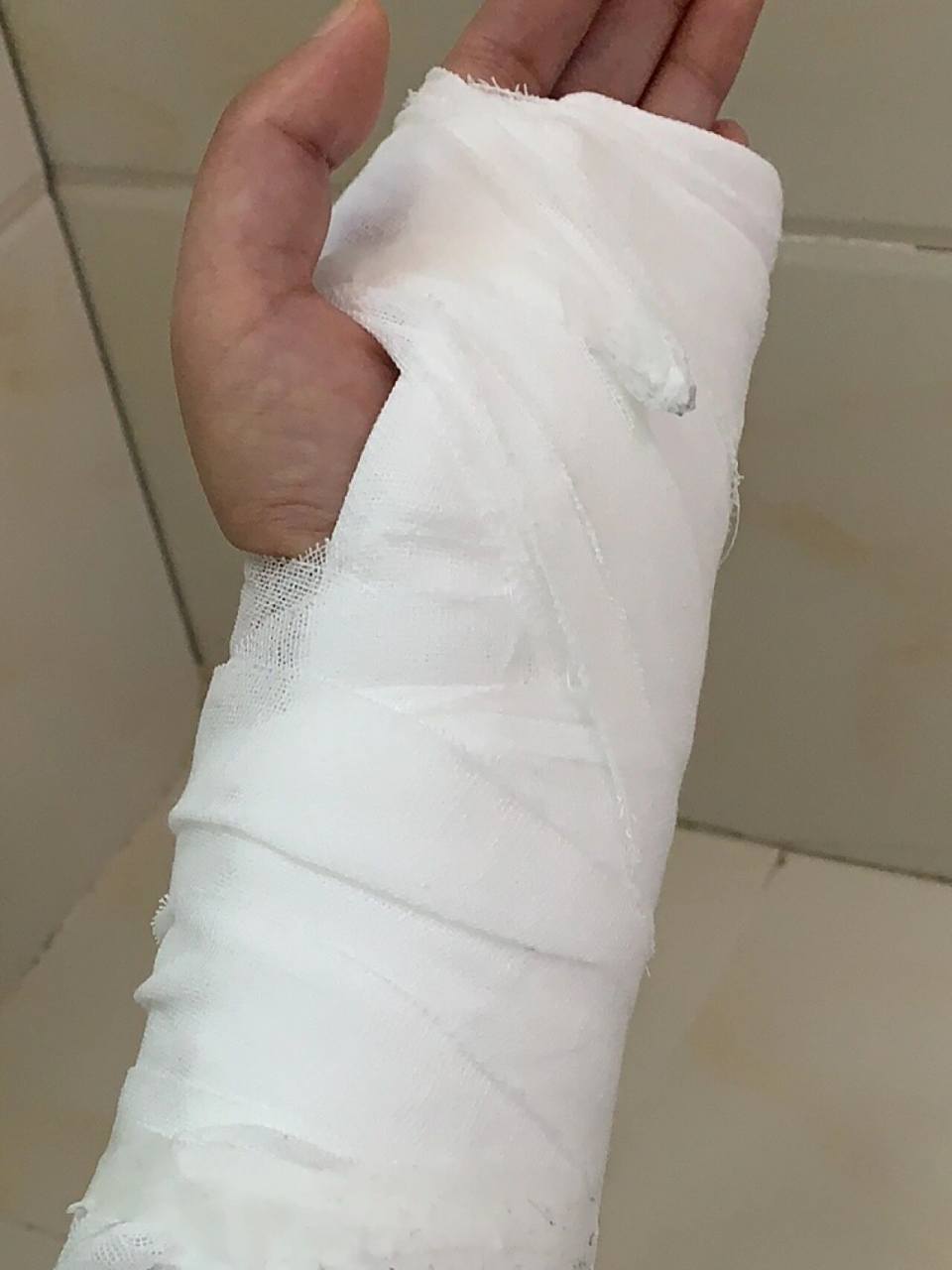 骨折 左手手舟骨折可真太难了