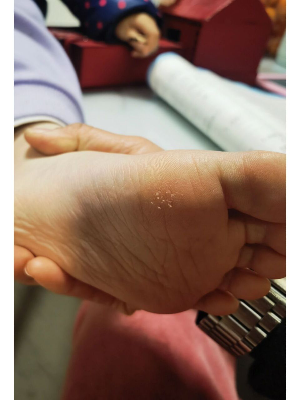 冬天脚掌长毛刺 小孩冬天脚掌总是长毛刺,怎么回事?