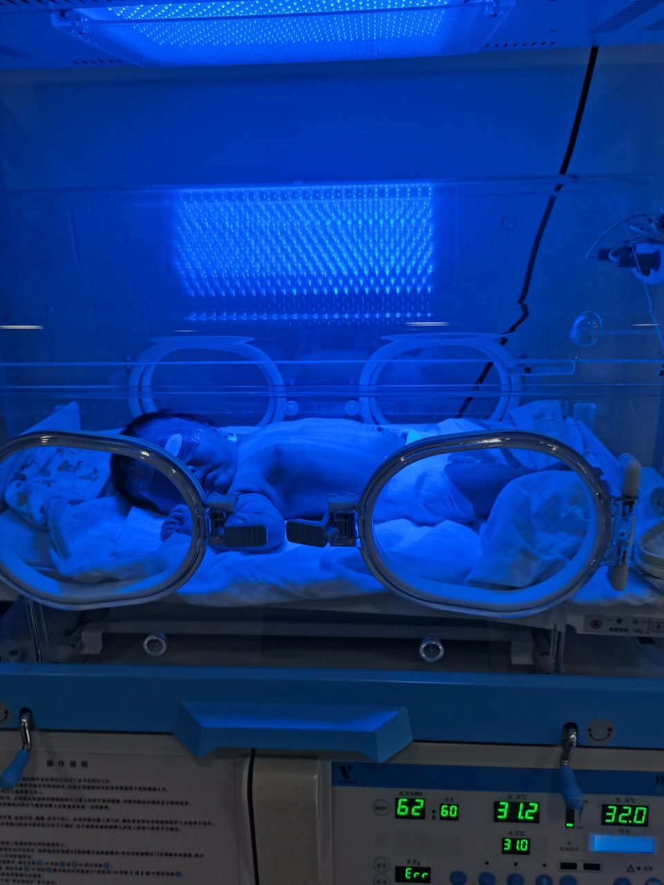 新生儿蓝光治疗是通过光照皮肤治疗新生儿黄疸.