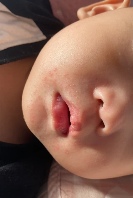 宝宝嘴巴周围出现小红点,常见原因包括物理性皮炎和接触性皮炎