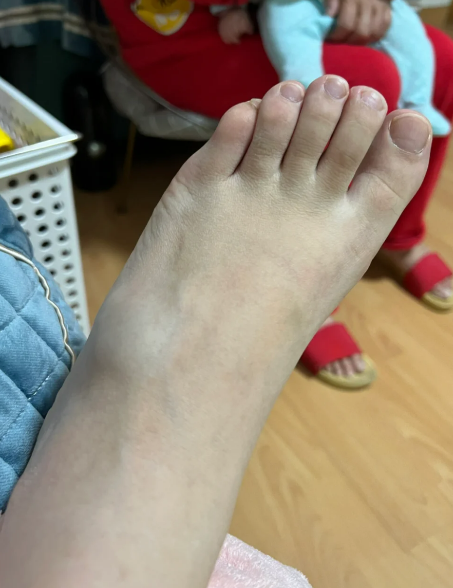 脚崴了脚面肿了个包,可能是软骨组织损伤或者撕脱骨折引起的