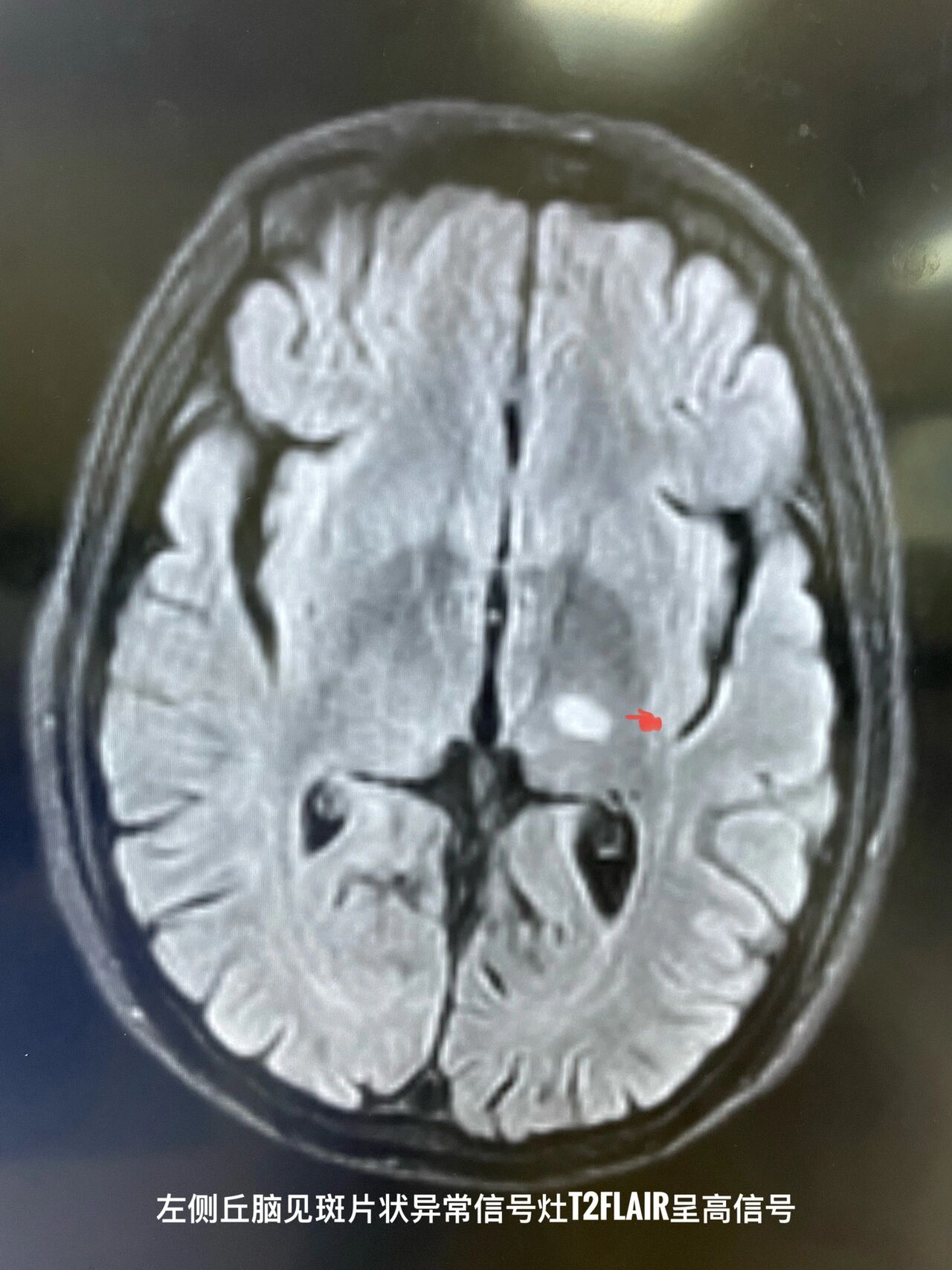 95亚急性脑梗死mri影像学习