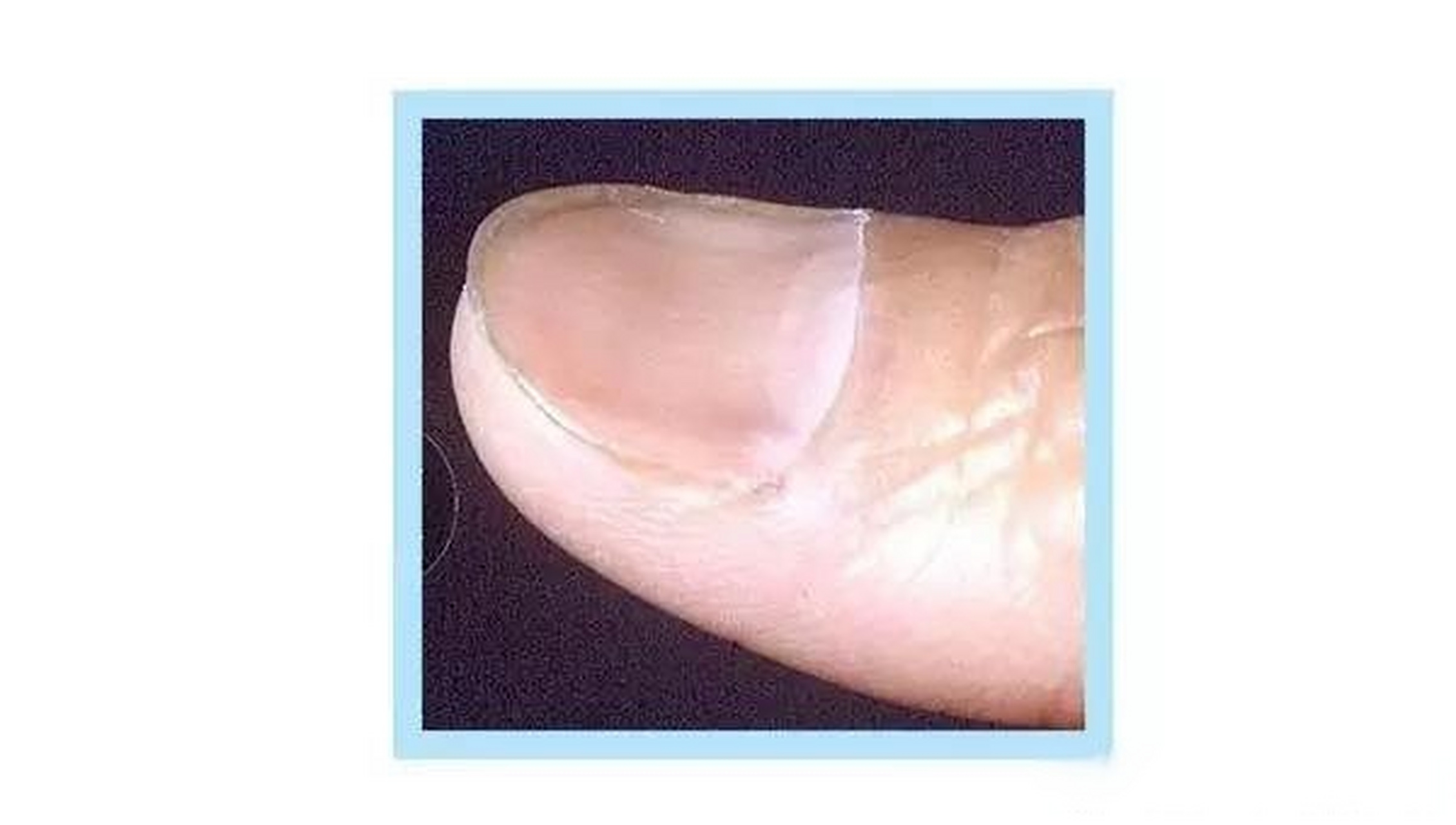 说一个异常的指甲类型——匙状甲 这种指甲,大家在平时说不定见过.