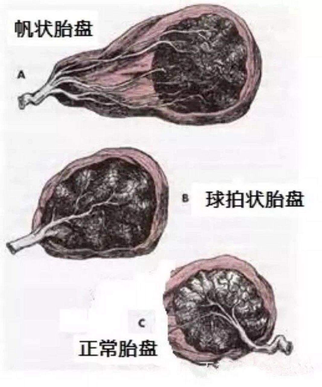 球拍状胎盘和子宫肌瘤 好孕笔记—问题篇3 孕19周给宝宝照了个二级