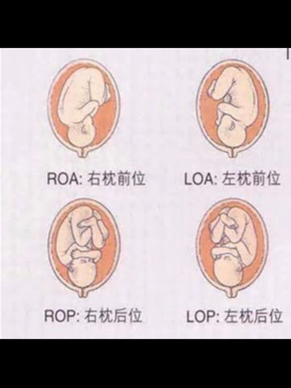 胎儿右枕前位图片图片