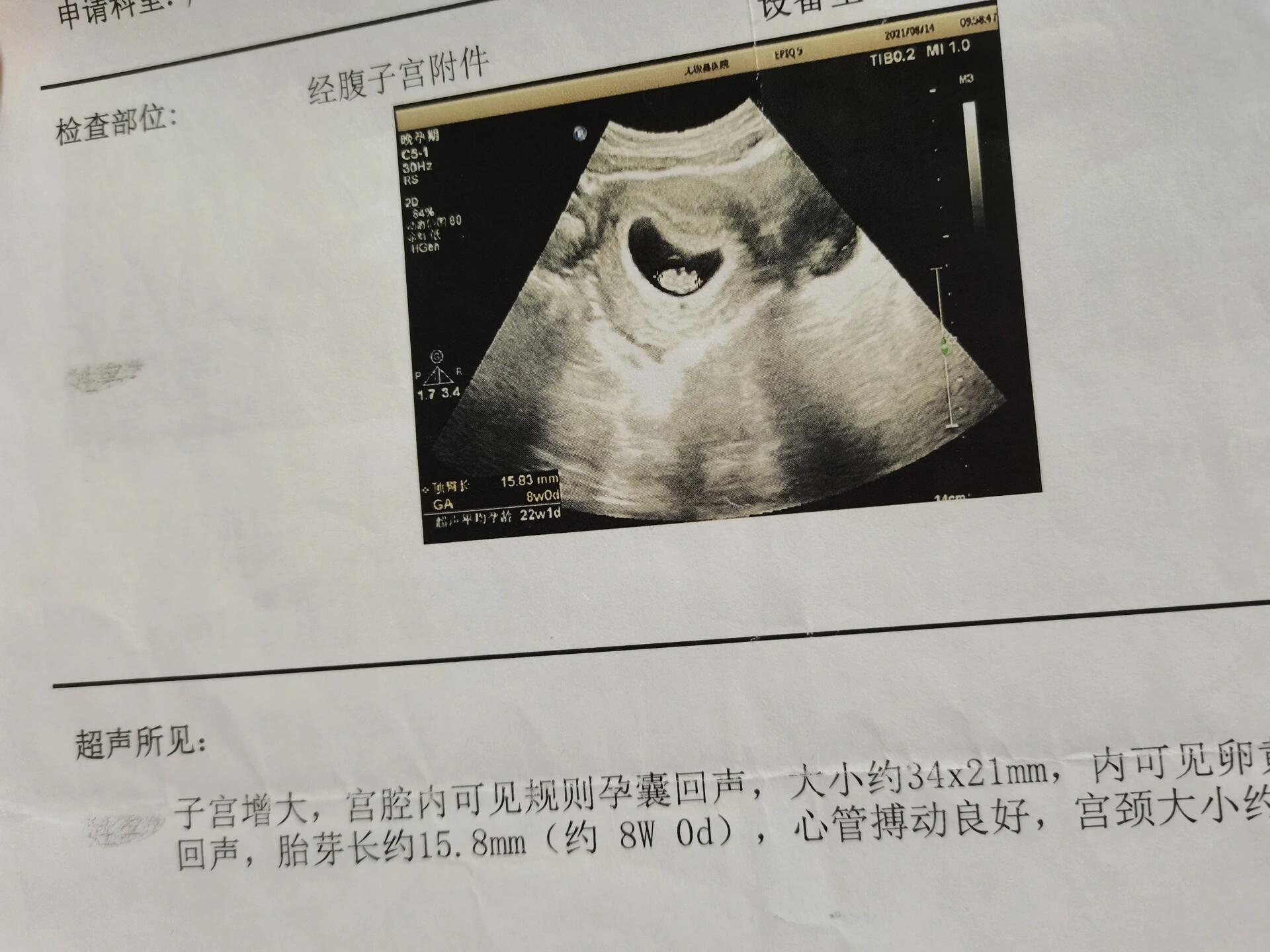 1️ 孕囊长型