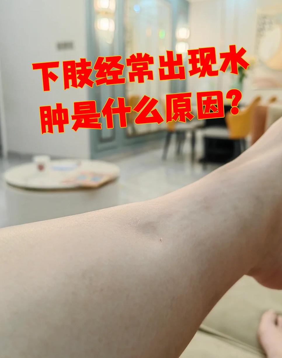 下肢经常水肿可能由多种原因引起