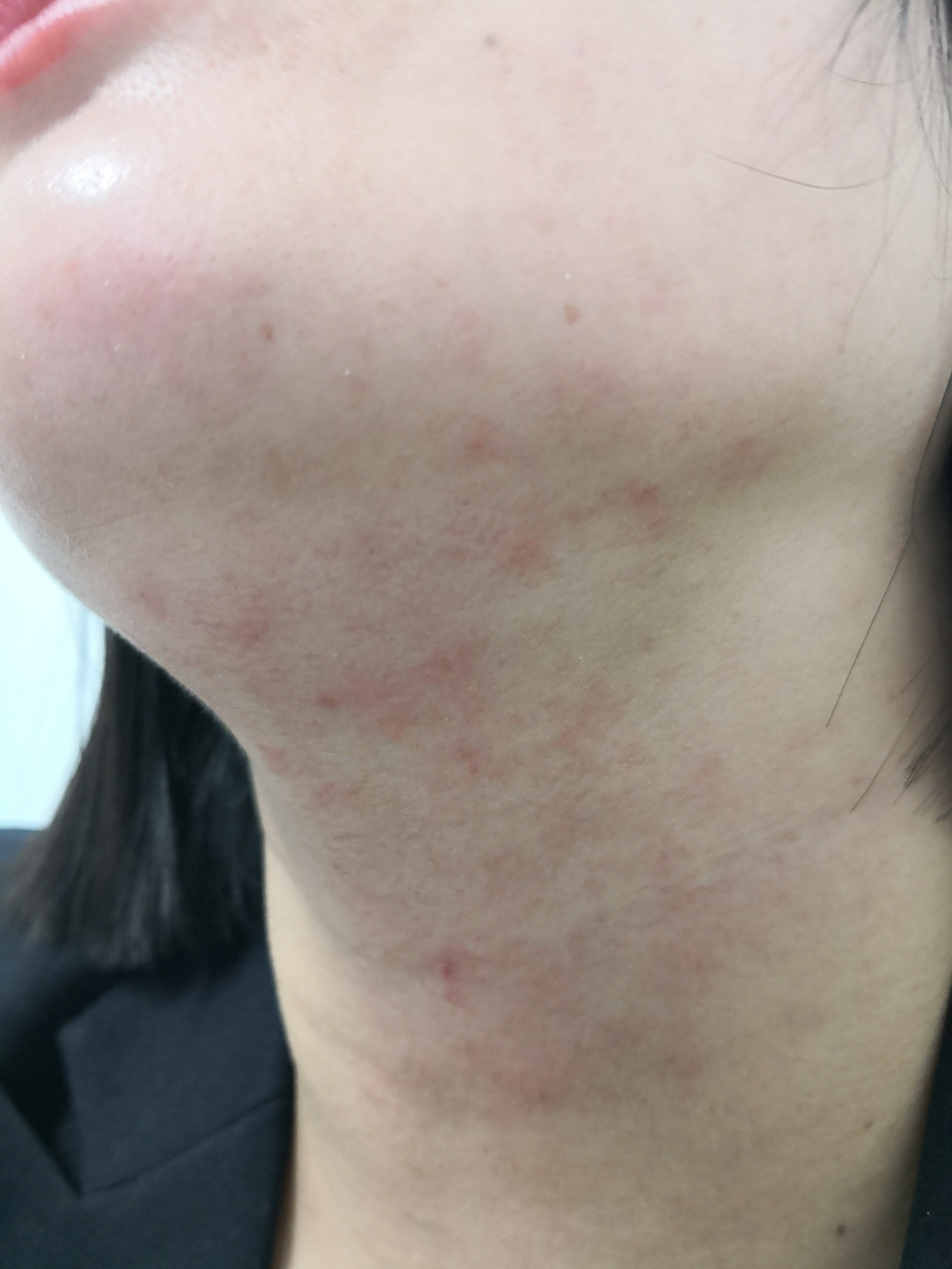 颈部接触性皮炎症状#过敏