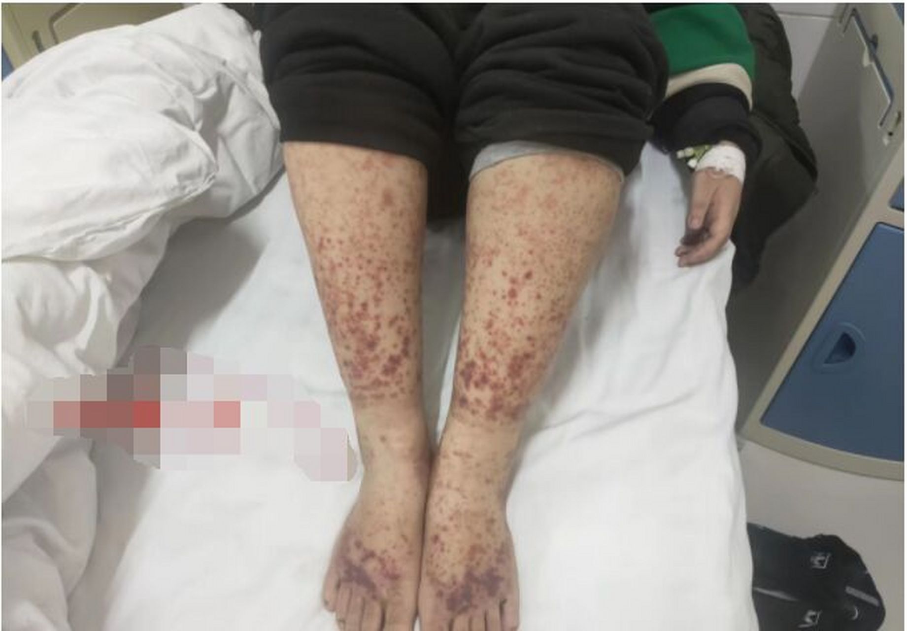 过敏性紫癜咋治好 中西医结合显奇效 门诊经常可以见到过敏性紫癜的患