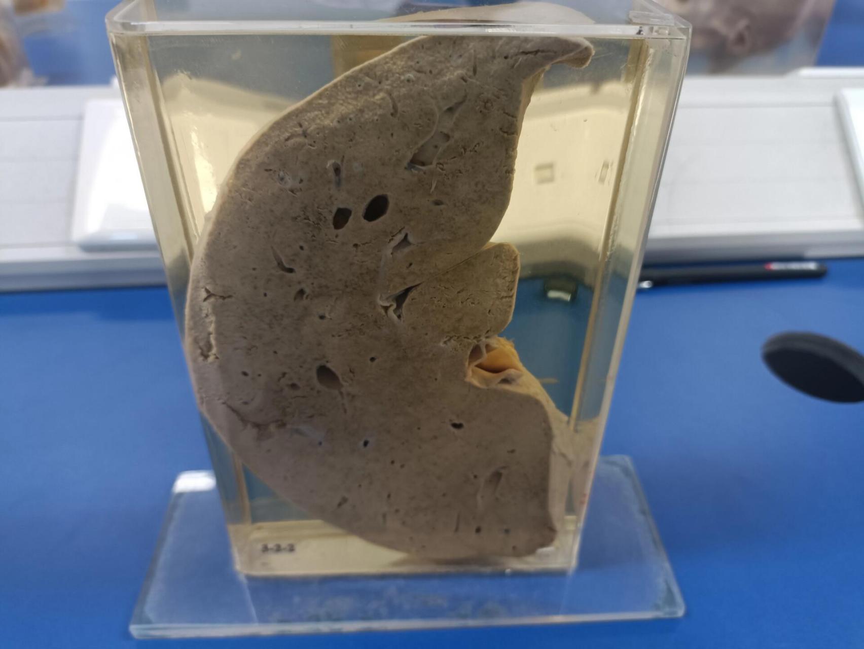 病理生理学大体标本学习 局部血液循环障碍 图1.