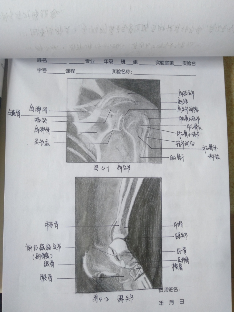 醫學影像學繪圖② 肩關節踝關節 colles骨折 椎體結核