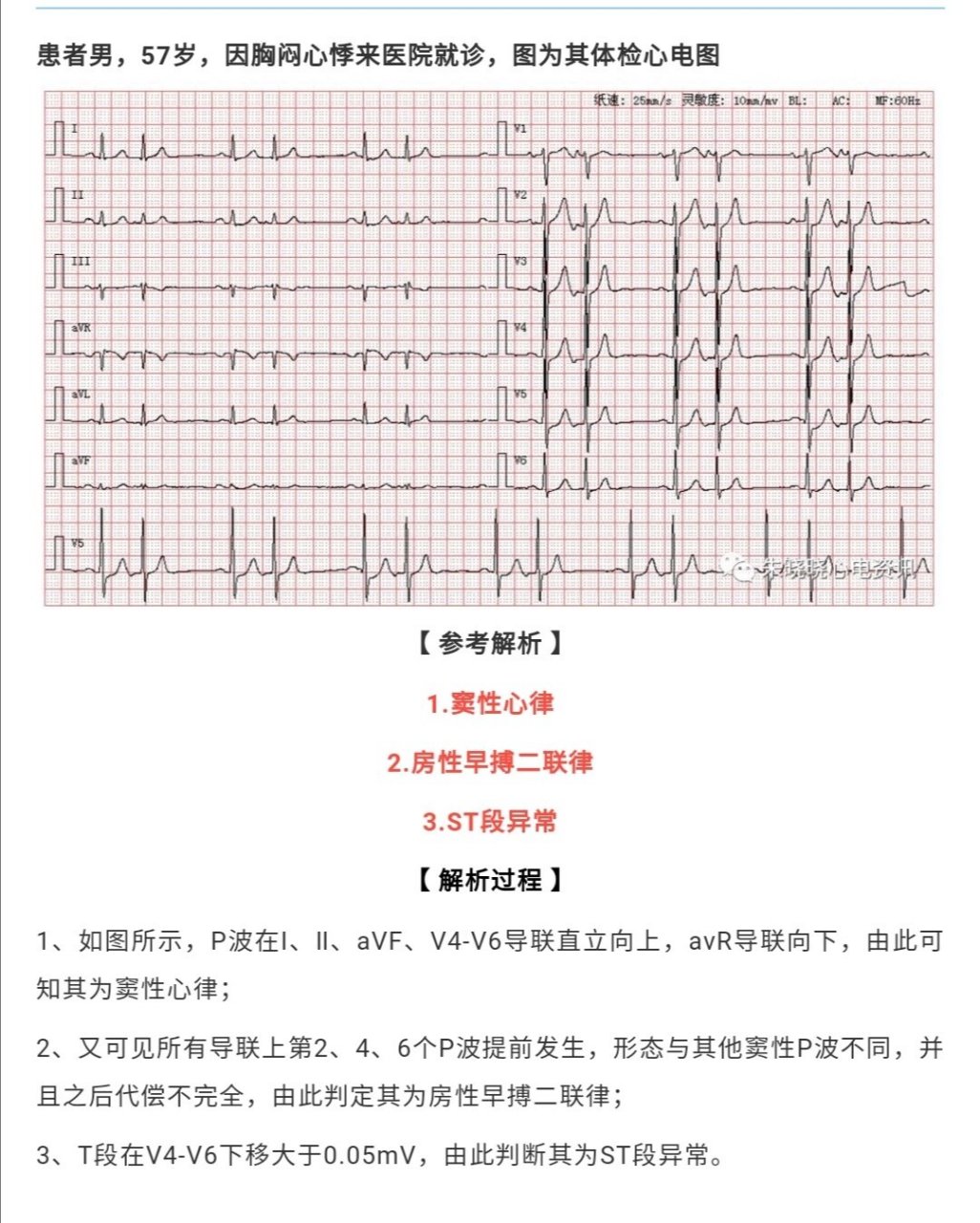 房性早搏二联律 房性早搏二联律 3