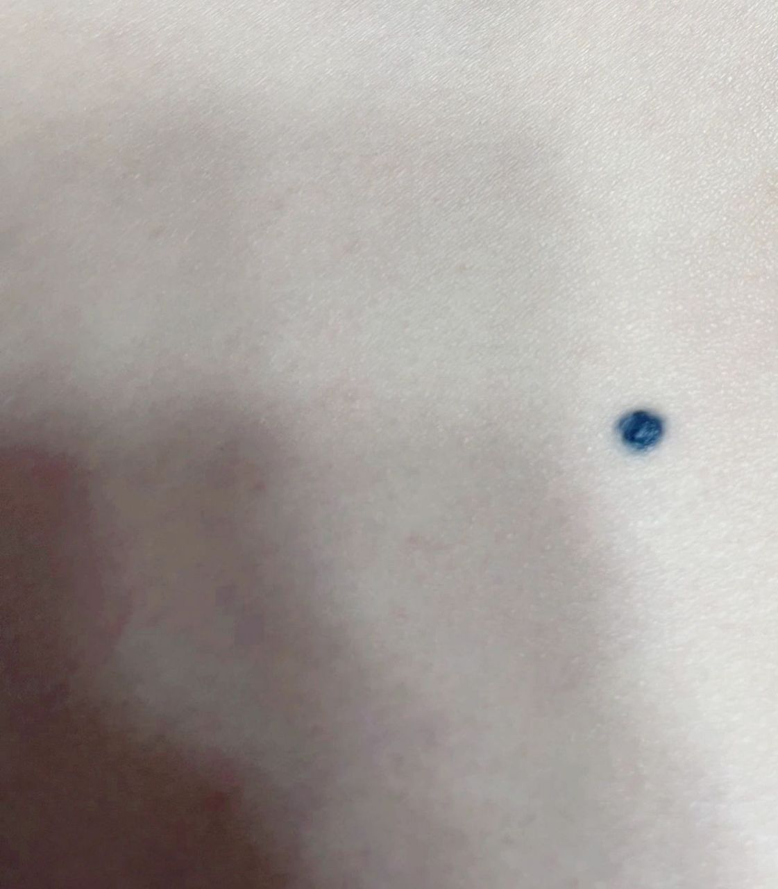 蓝痣切掉了 蓝痣 在臀部从小就有的一颗蓝黑色的痣,最近突然凸起来了