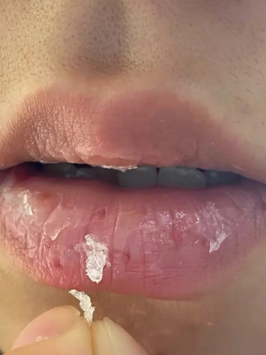 嘴唇总是干裂起皮,一般要根据具体原因来处理