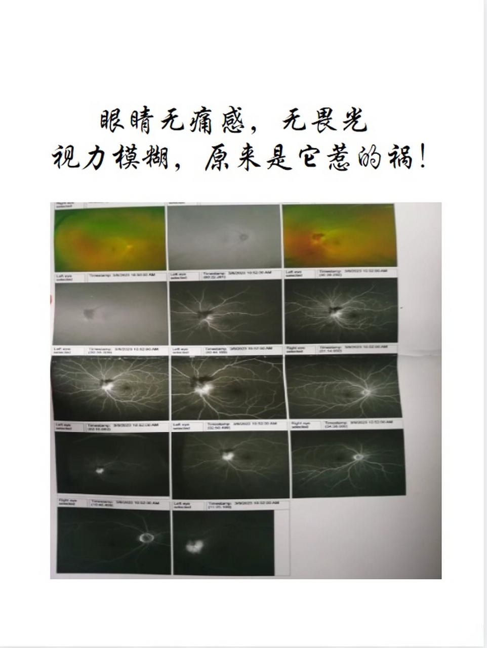 缺血性视神经病变中医这么治有效果!