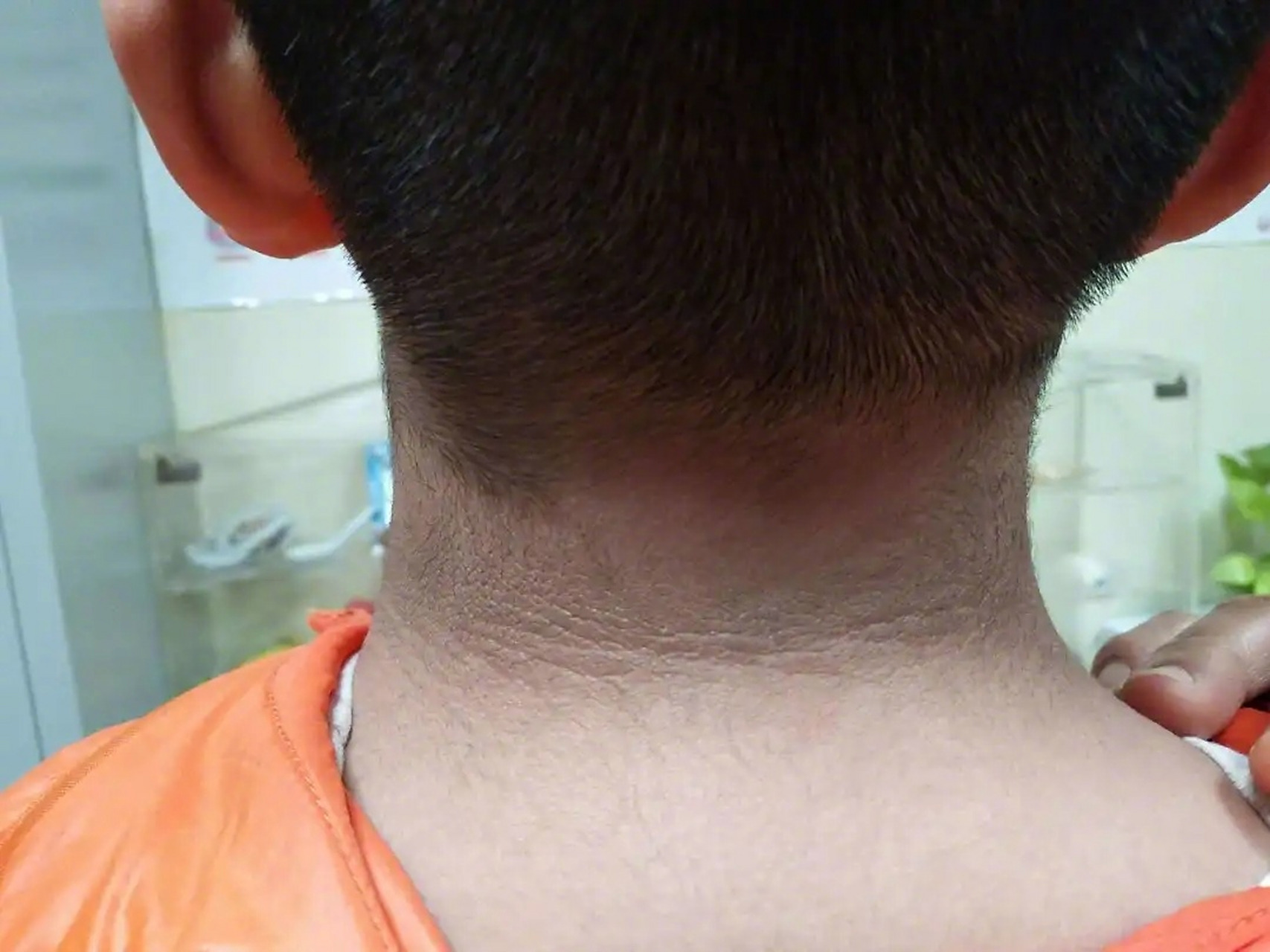 【脖子黑的人建议查查血糖】脖子上出现类似污垢的"泥",是一种皮肤病