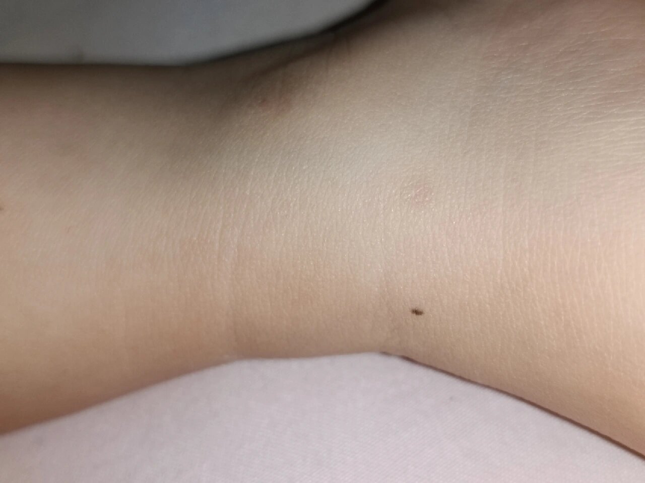 宝宝脚腕这儿长了颗痣