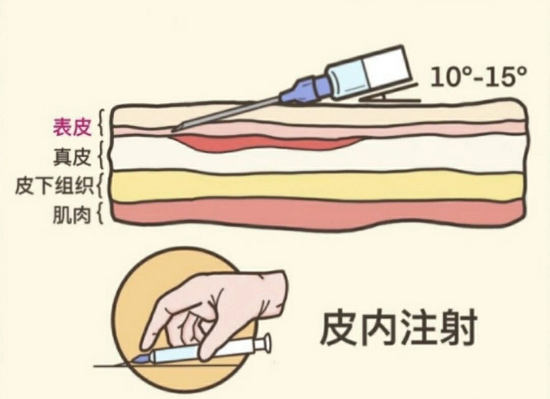 针头斜面向上的图片图片