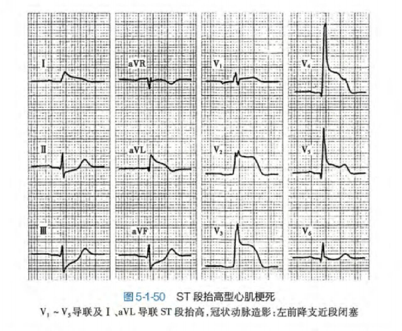 心电图等电位线是死了图片