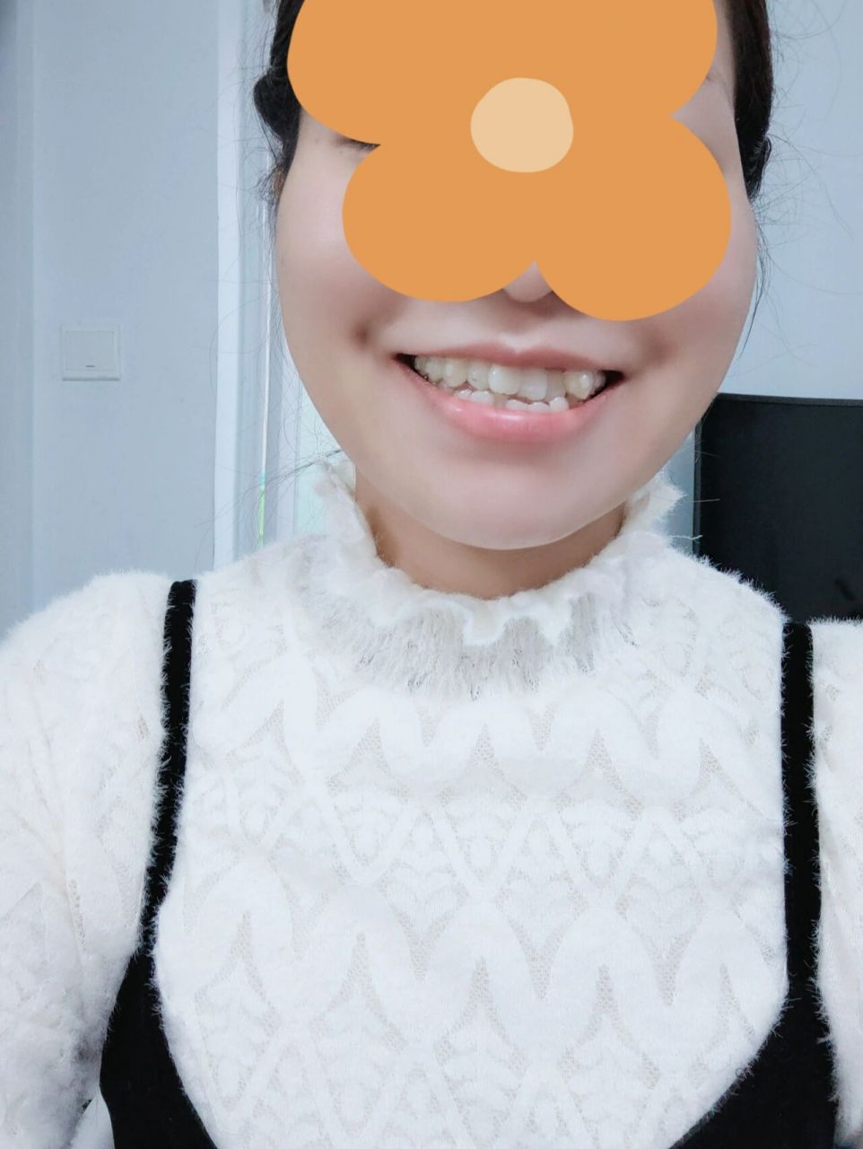 嘴角旁边这个窝算是梨涡吗 每次笑就会有这两个窝,不是法令纹,从小就