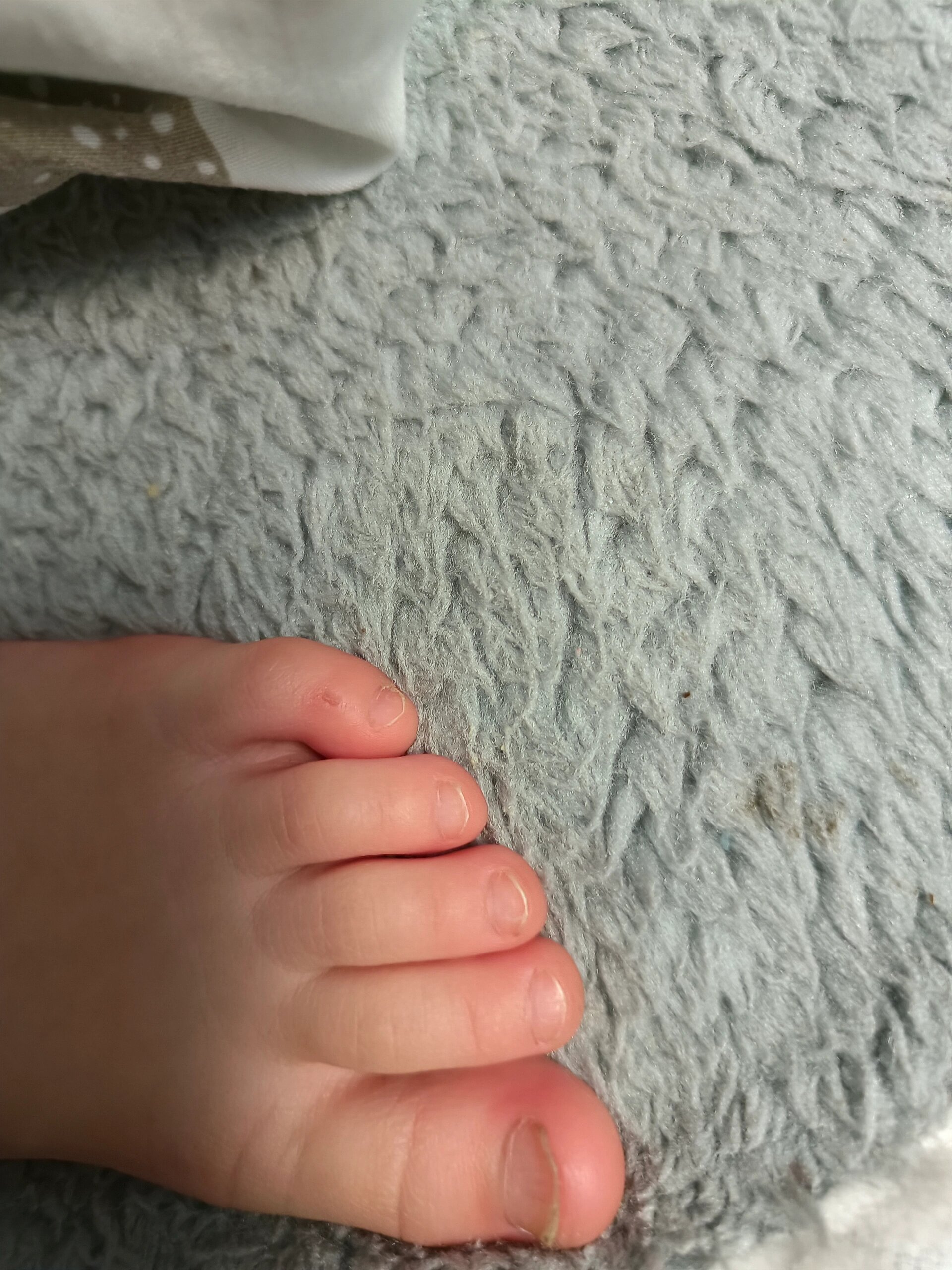 小孩的小脚指有点弯有没有什么问题啊