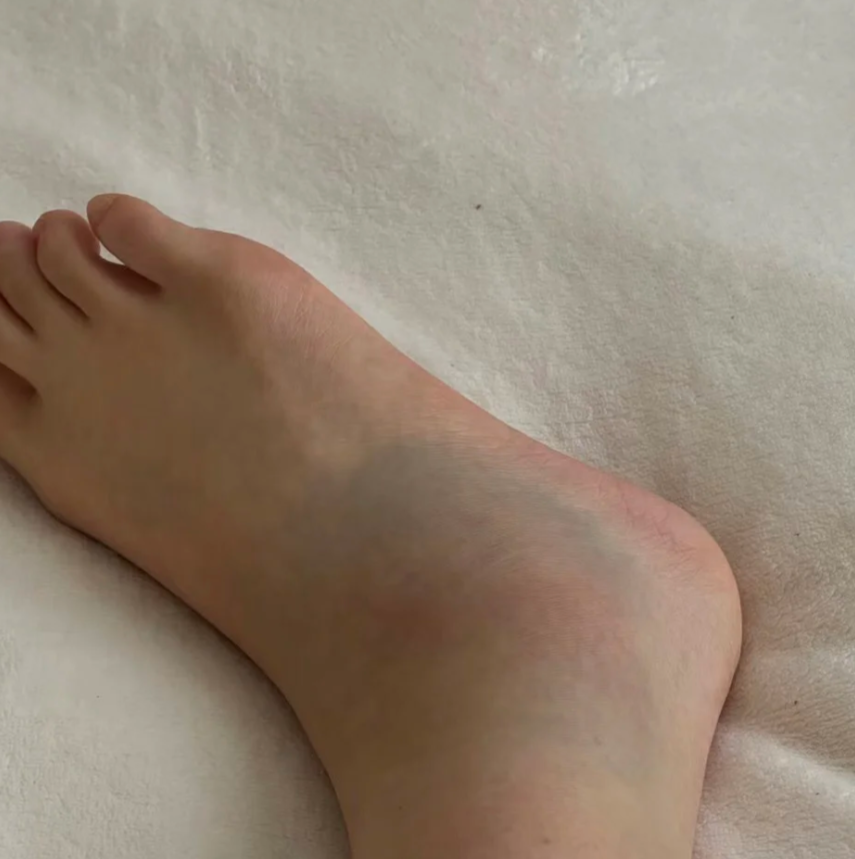 崴脚后不疼可能有几种原因