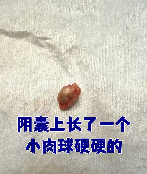 阴囊上长了个硬硬的小肉球,可能是皮脂腺囊肿,附睾结节或毛囊炎引起