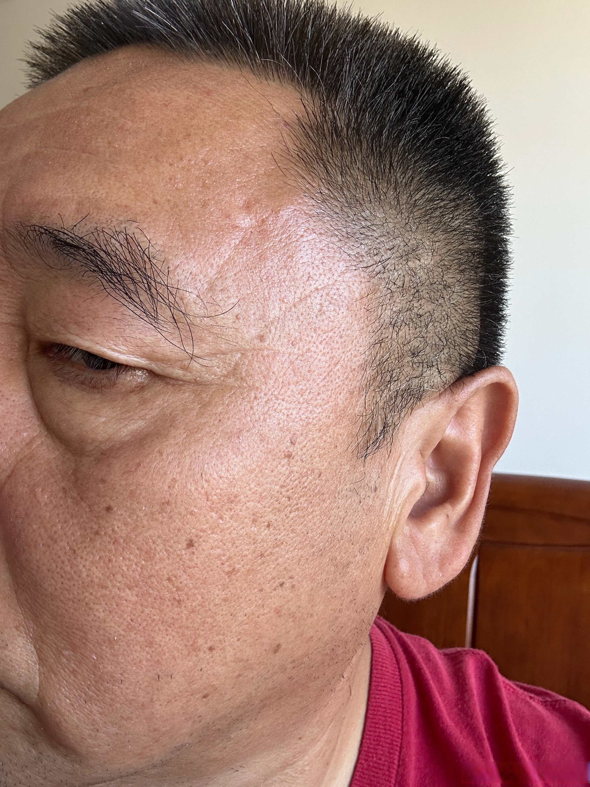 右眼眼角处也出出现了几条斜的纹路