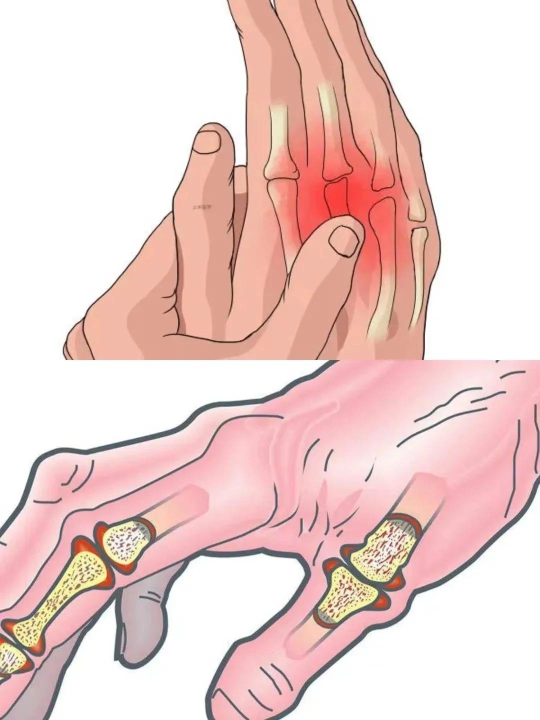 手指风湿痛是一种常见的骨科疾病