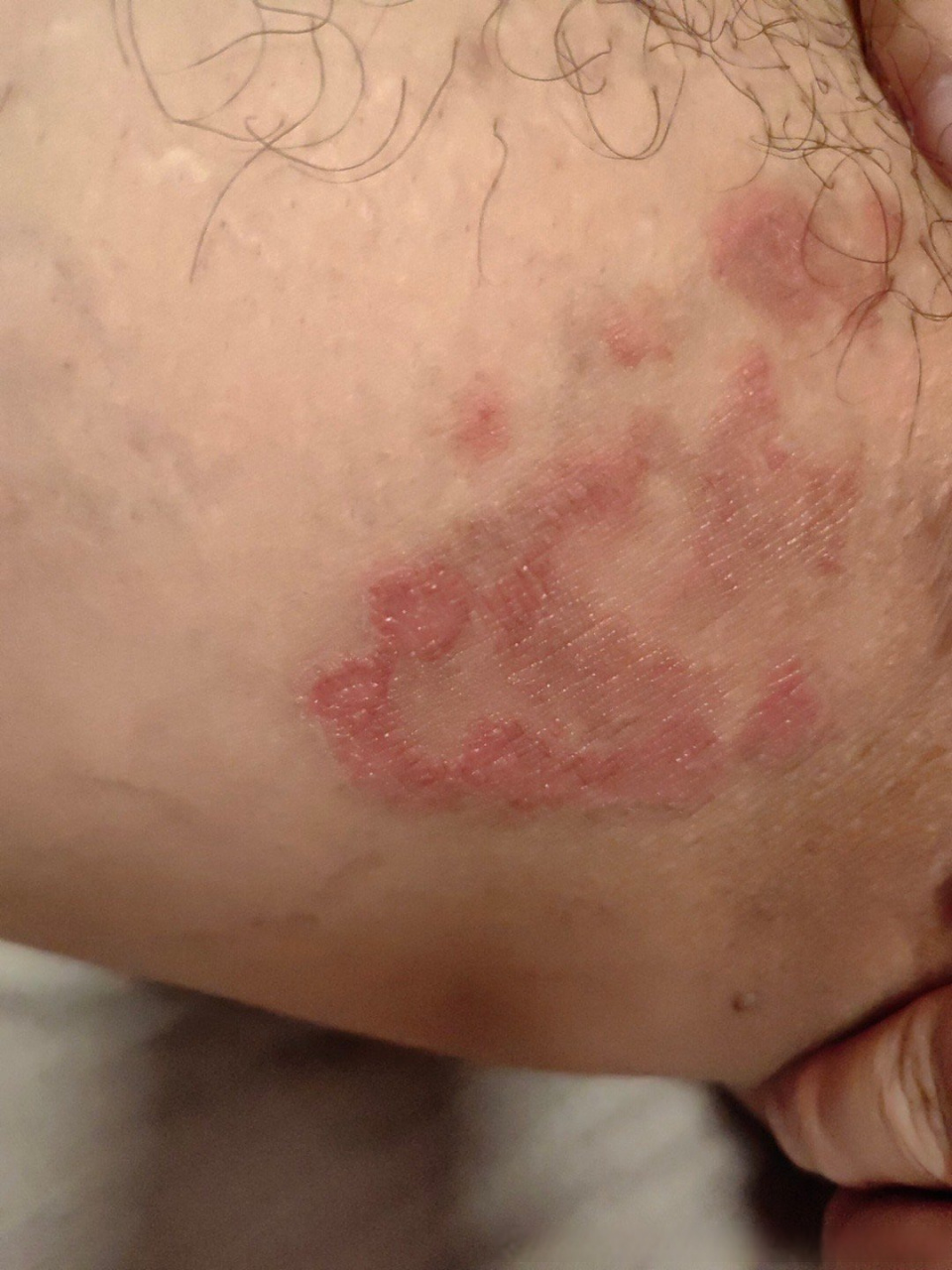 皮肤健康科普# 最近大腿根出现这种疹子,有点破了,病因不明.