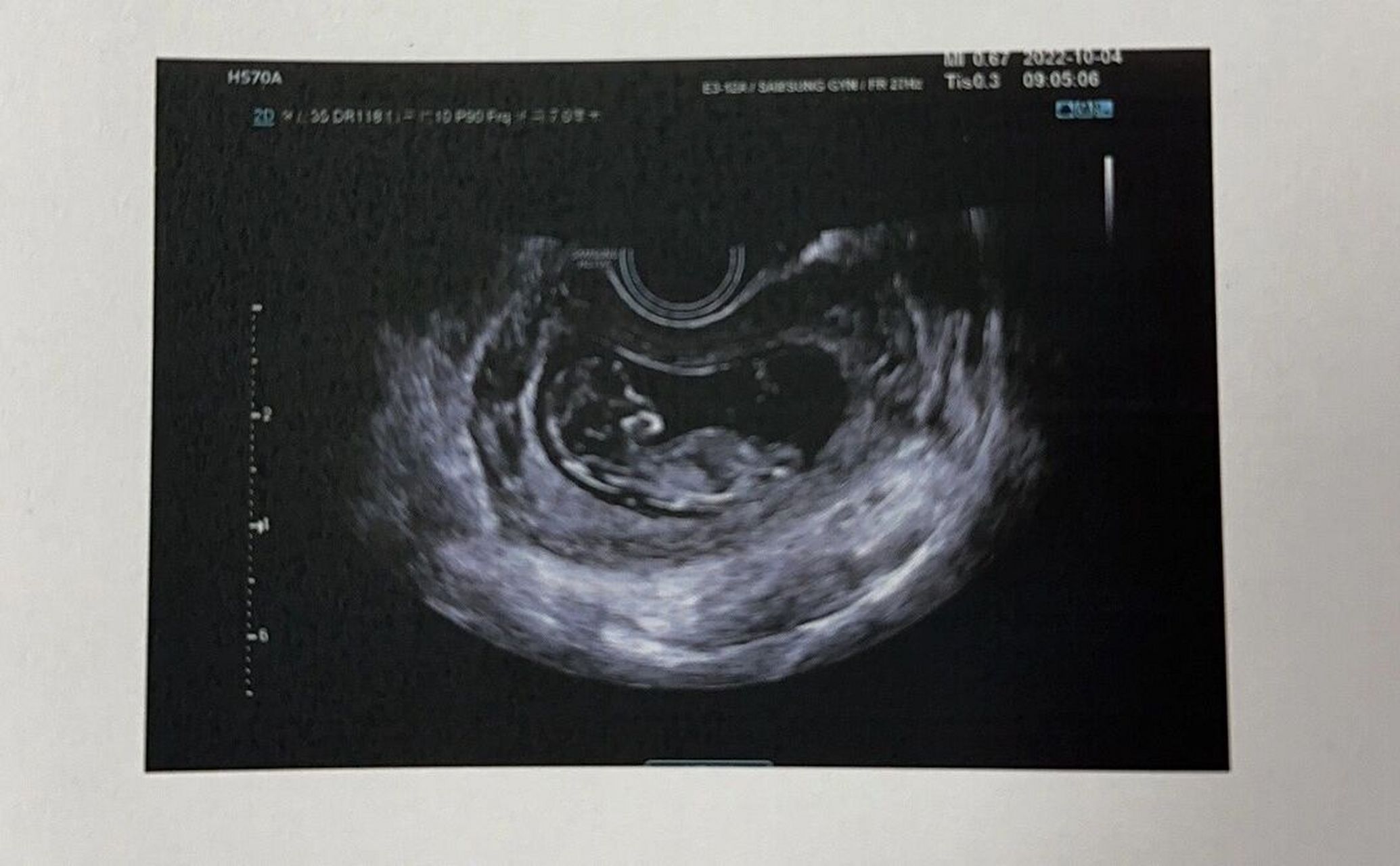 孕11周宝宝正式成小胎儿啦 — 天天孕反终于熬到了11周,孕反稍微好了