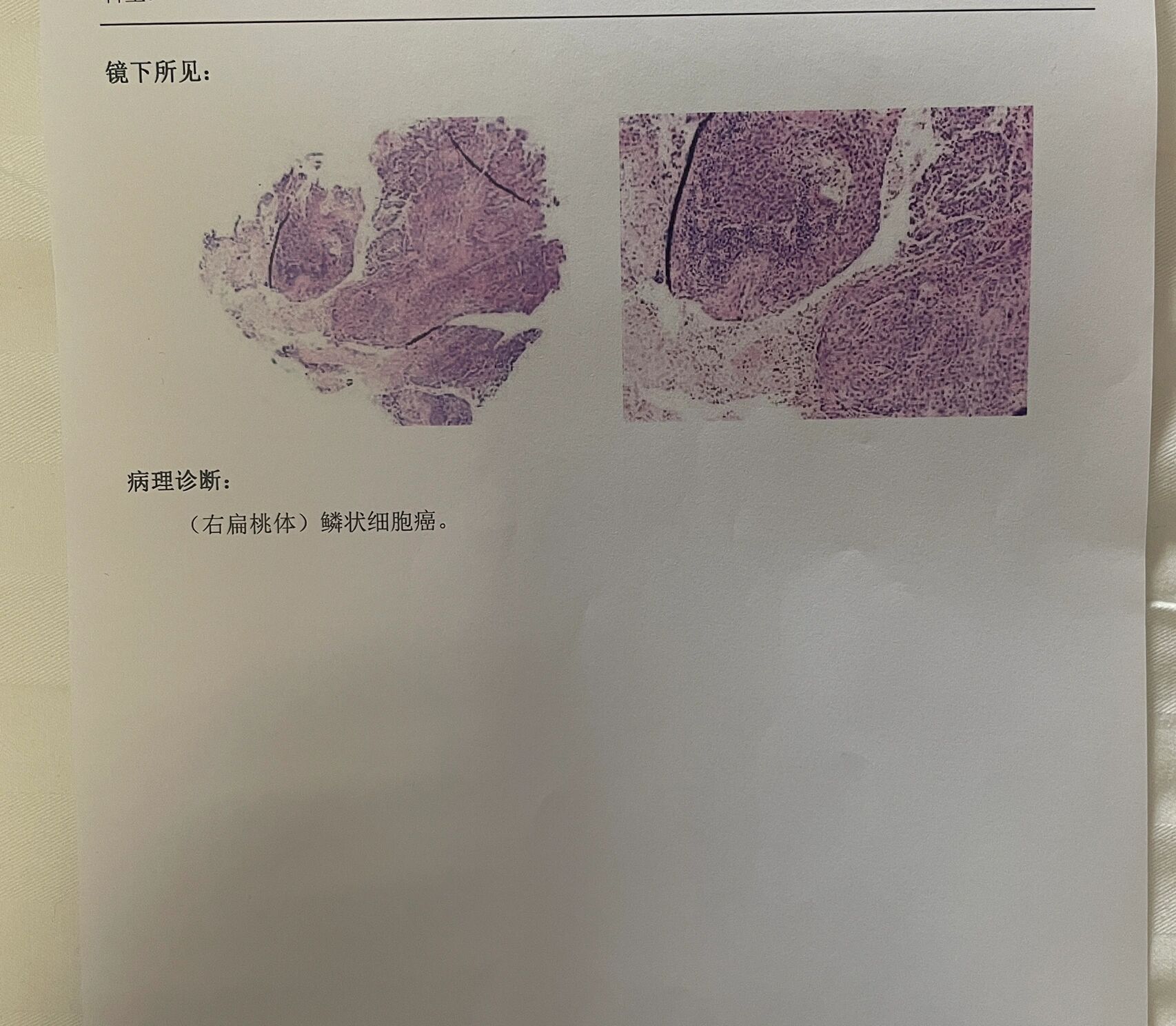 晴天霹雳 扁桃体鳞癌远处转移 爸爸最近刚查出扁桃体鳞癌,做了pet ct