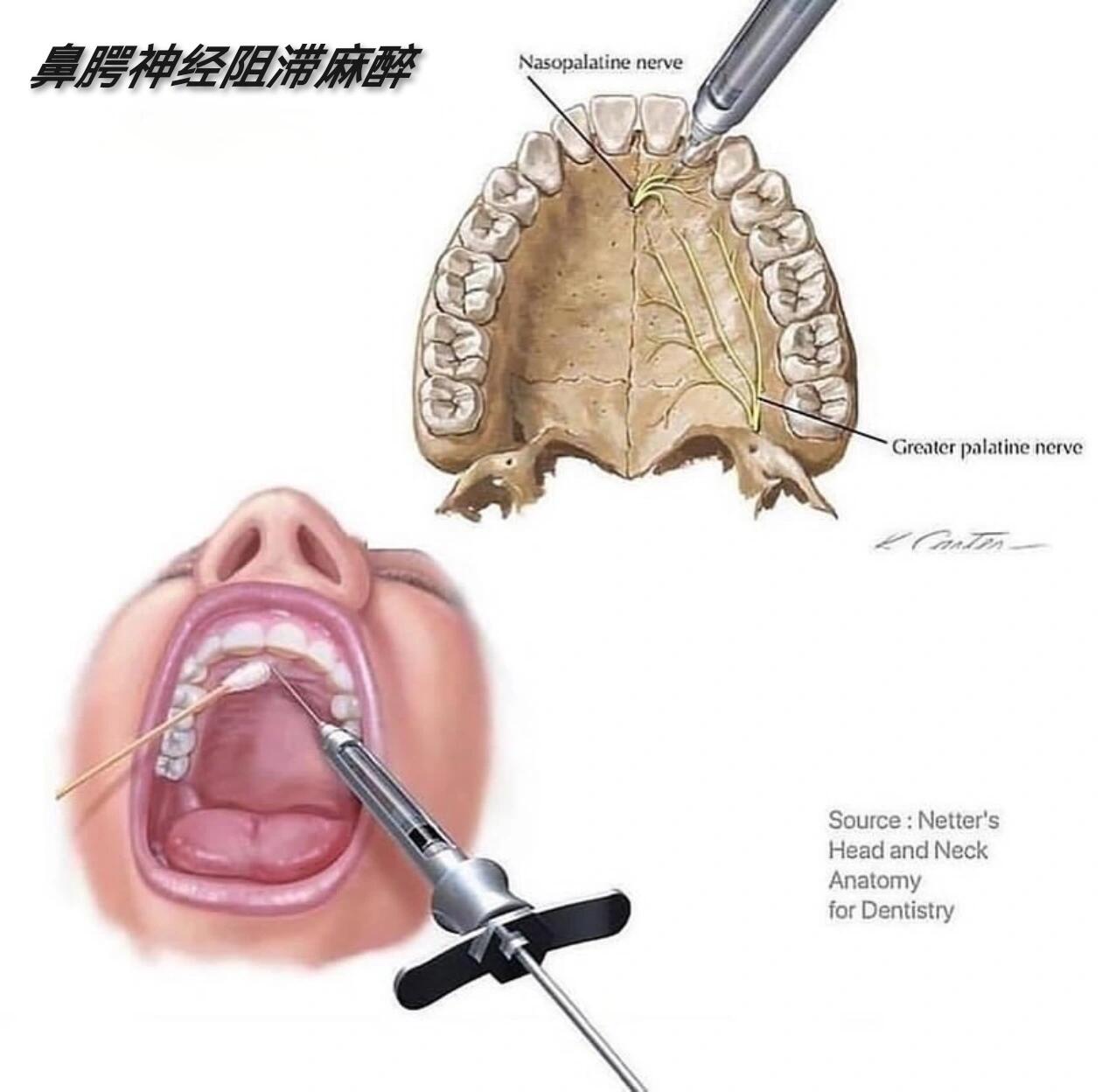 侧隐窝神经阻滞术图片