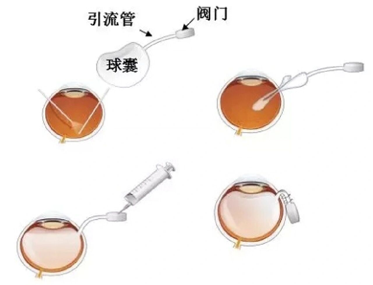 现在小助手就简单说一说球囊在我们妇产科方面的运用宫腔镜放置球囊